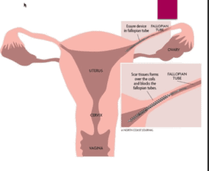 Essure Lawsuits The Lovely Law Firm